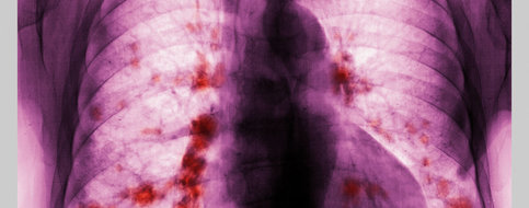 Cancer du poumon: de nouveaux espoirs pour les formes précoces